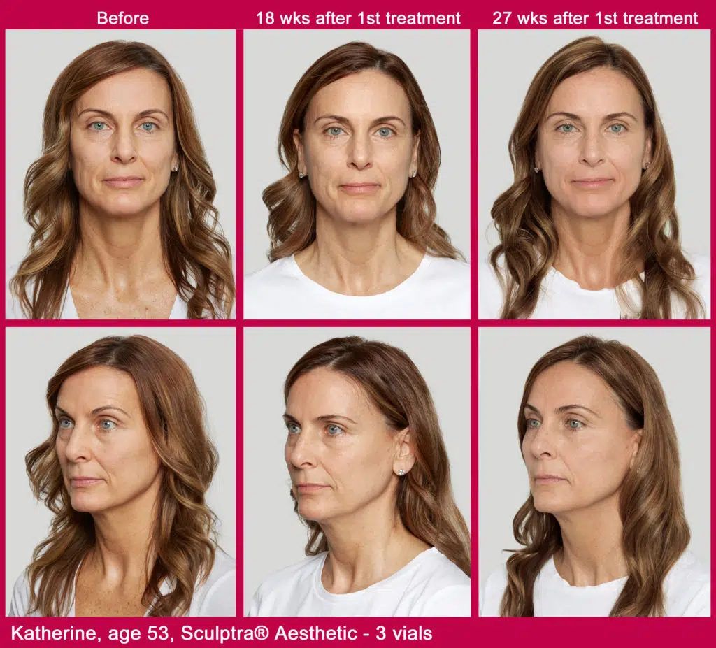 Before and after Sculptra results