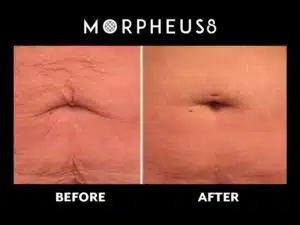 Before and after Morpheus8 Body results