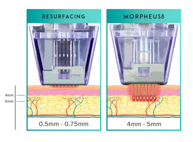 Photo showing the depths that Morpheus8 can penetrate the skin, which is much deeper than other resurfacing devices